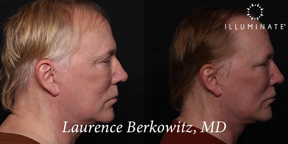 Blepharoplasty Before & After Image