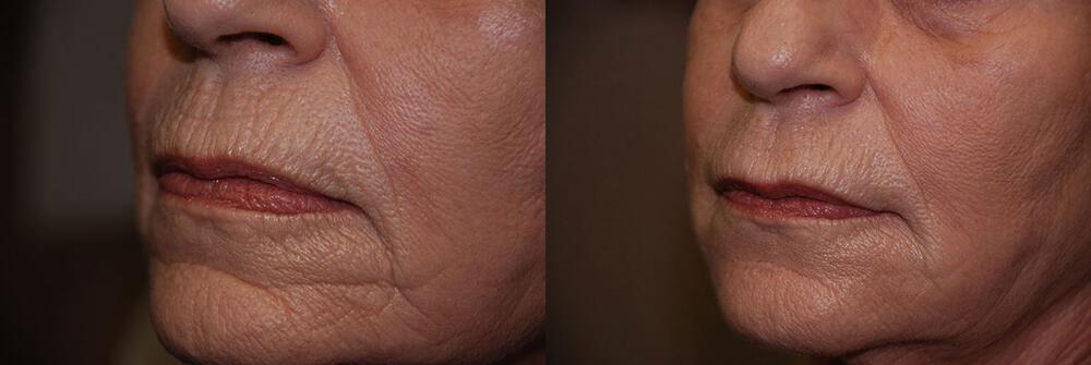 Dermal Fillers Before & After Image