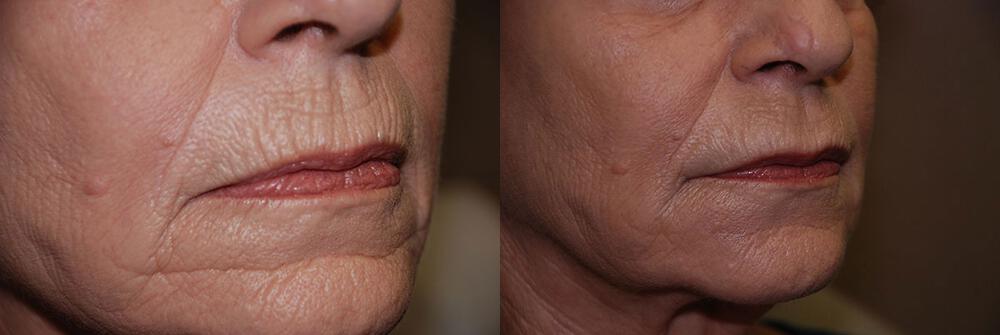 Dermal Fillers Before & After Image