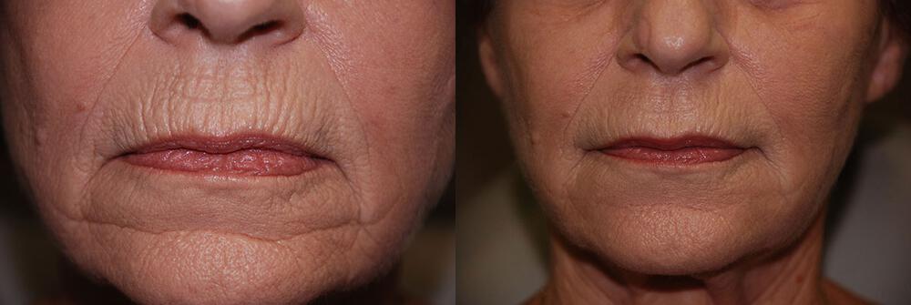 Dermal Fillers Before & After Image