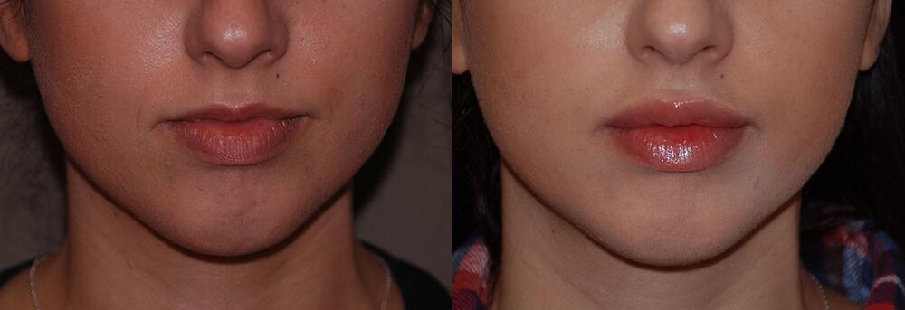 Dermal Fillers Before & After Image