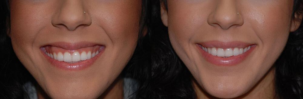 Dermal Fillers Before & After Image