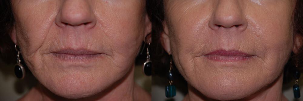 Dermal Fillers Before & After Image