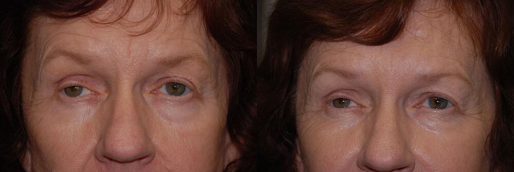 Dermal Fillers Before & After Image