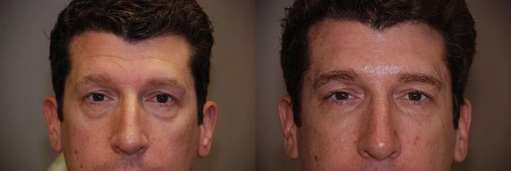 Dermal Fillers Before & After Image