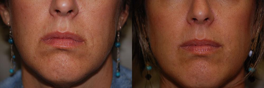 Dermal Fillers Before & After Image