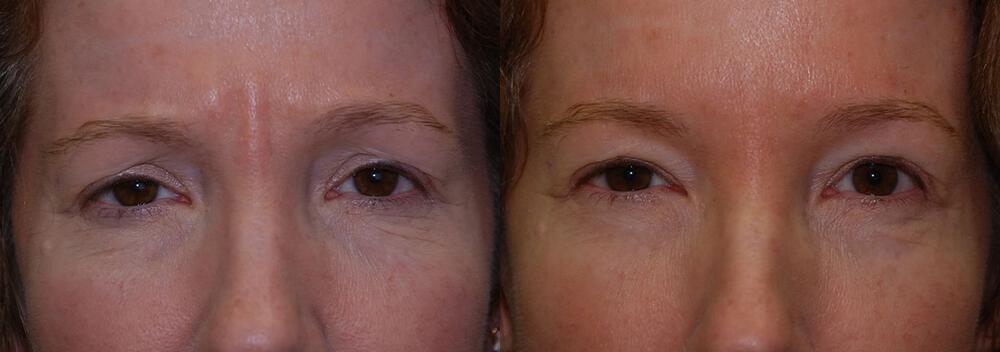 Dermal Fillers Before & After Image