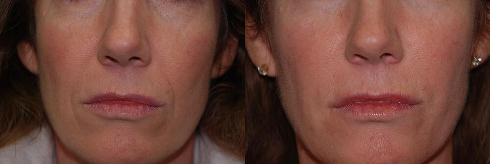 Dermal Fillers Before & After Image