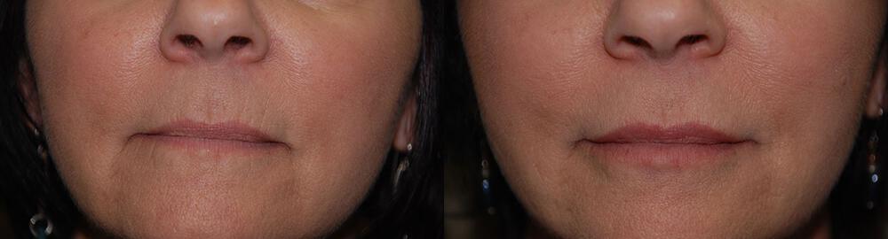 Dermal Fillers Before & After Image