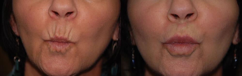 Dermal Fillers Before & After Image