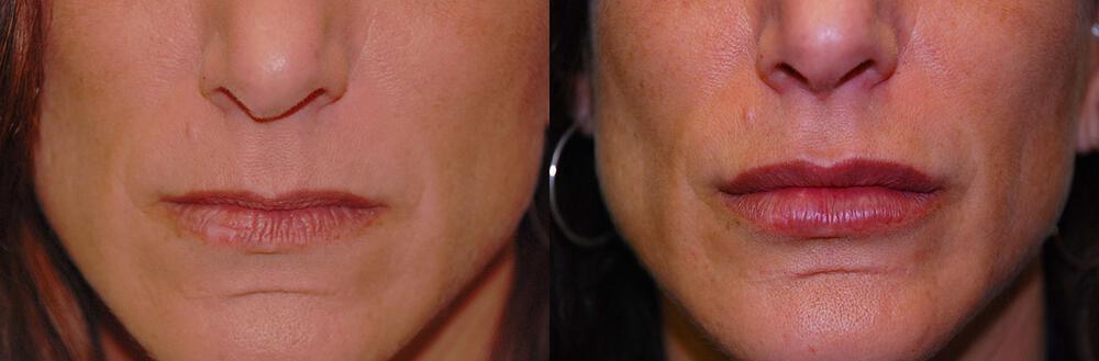 Dermal Fillers Before & After Image