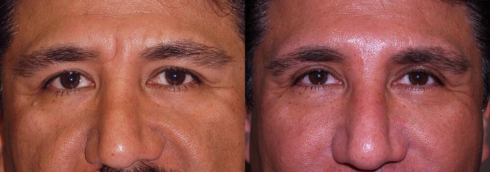 Dermal Fillers Before & After Image