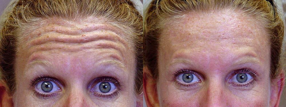 Dermal Fillers Before & After Image