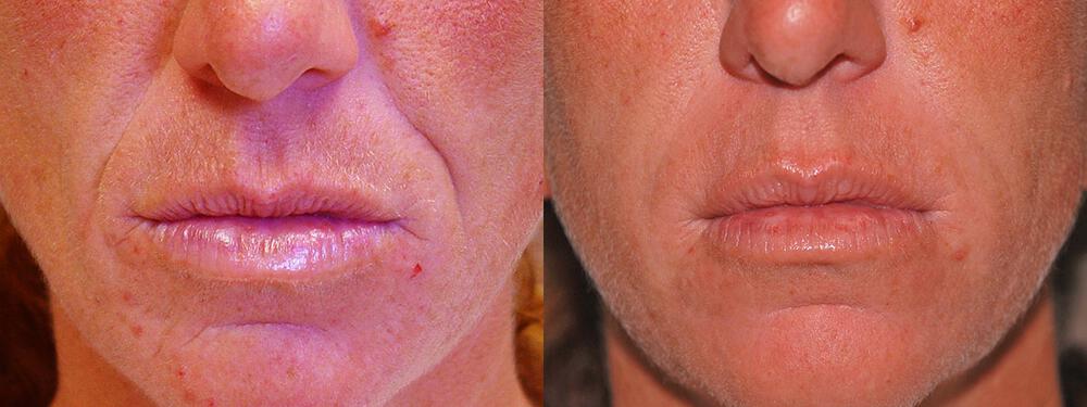 Dermal Fillers Before & After Image