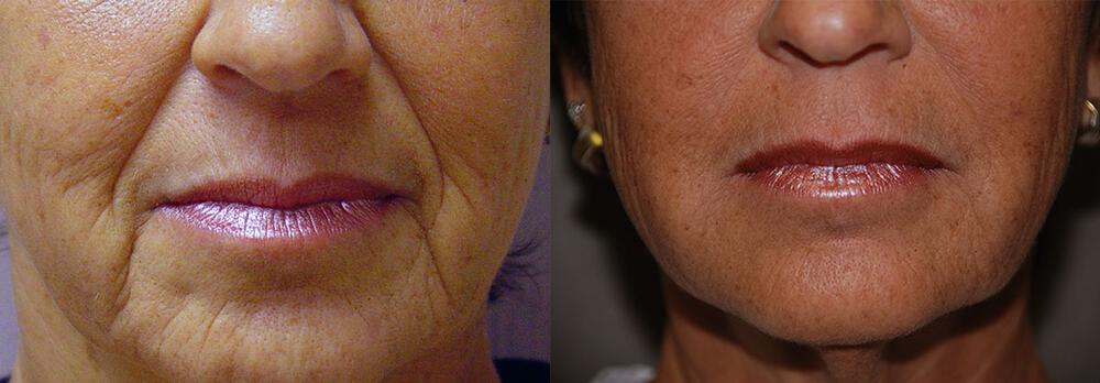 Dermal Fillers Before & After Image