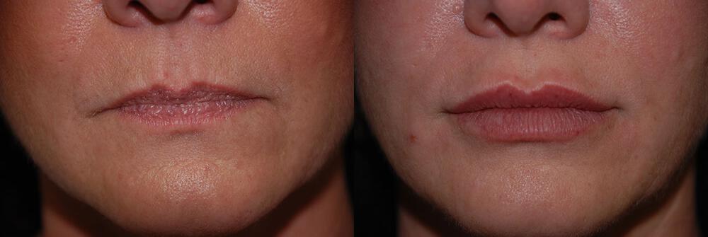 Dermal Fillers Before & After Image