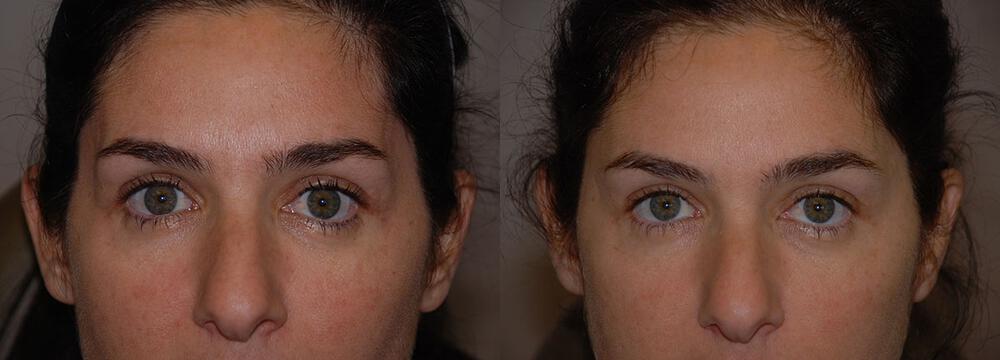 Dermal Fillers Before & After Image