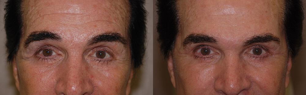 Dermal Fillers Before & After Image