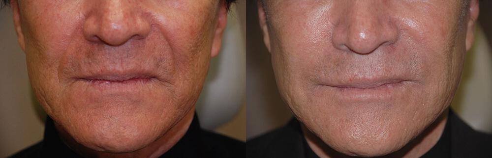 Dermal Fillers Before & After Image