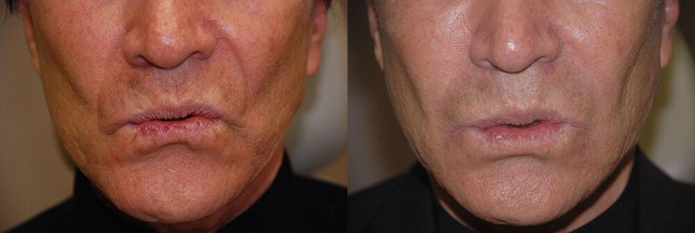 Dermal Fillers Before & After Image