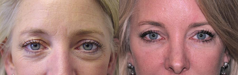 Dermal Fillers Before & After Image