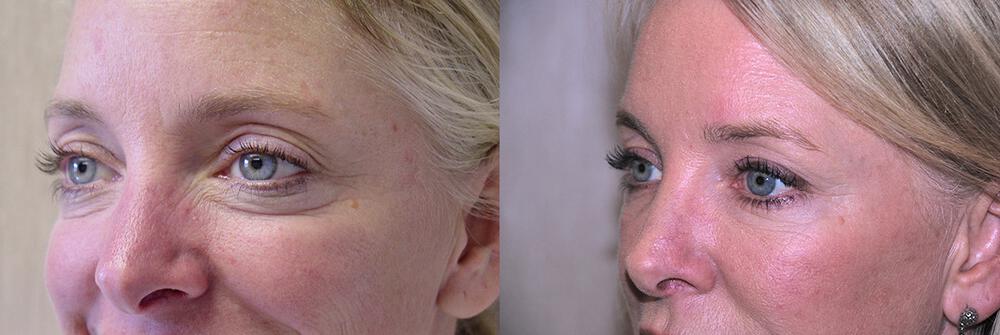 Dermal Fillers Before & After Image