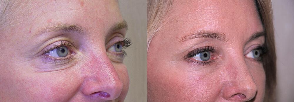 Dermal Fillers Before & After Image