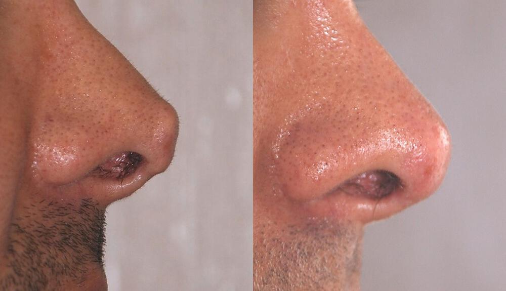 Dermal Fillers Before & After Image