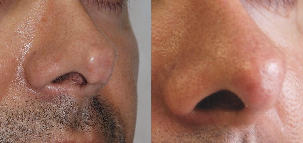 Dermal Fillers Before & After Image