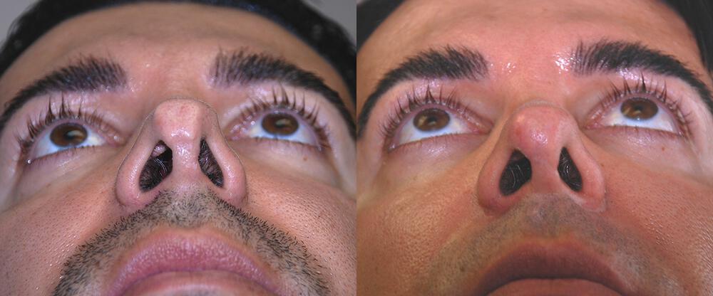 Dermal Fillers Before & After Image