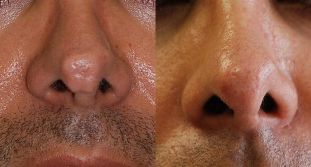 Dermal Fillers Before & After Image