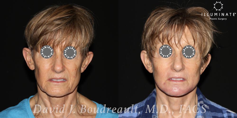 Face & Neck Lift Before & After Image