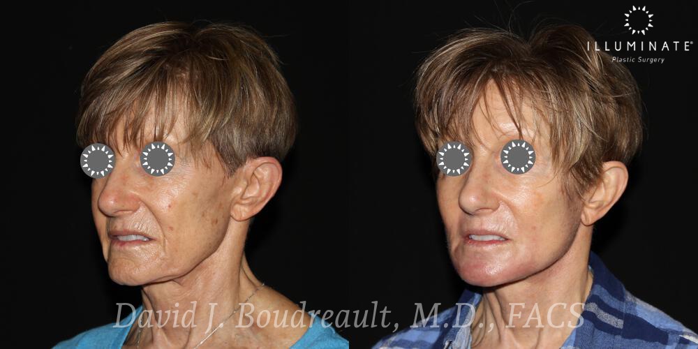 Face & Neck Lift Before & After Image