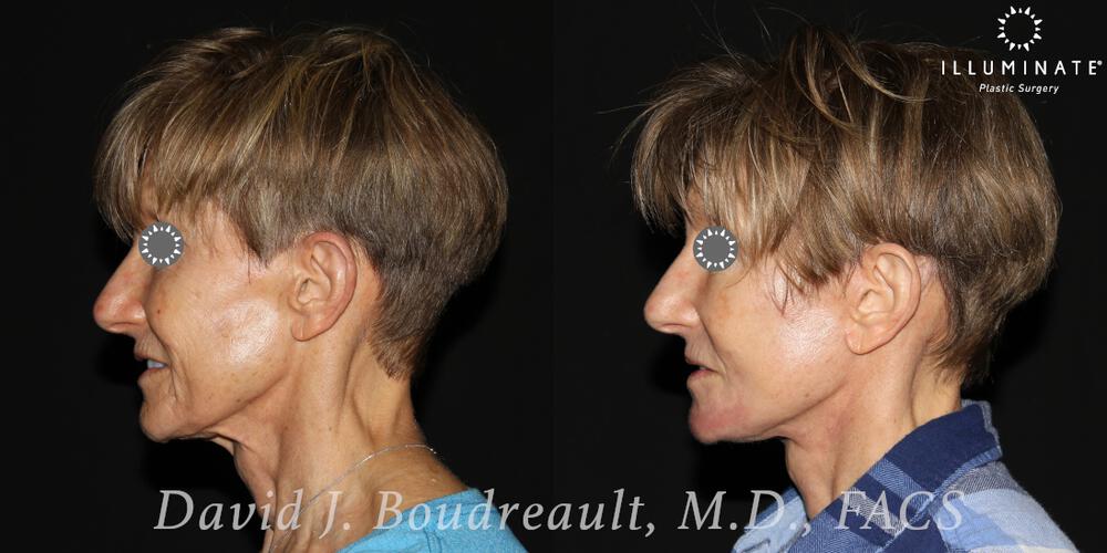 Face & Neck Lift Before & After Image