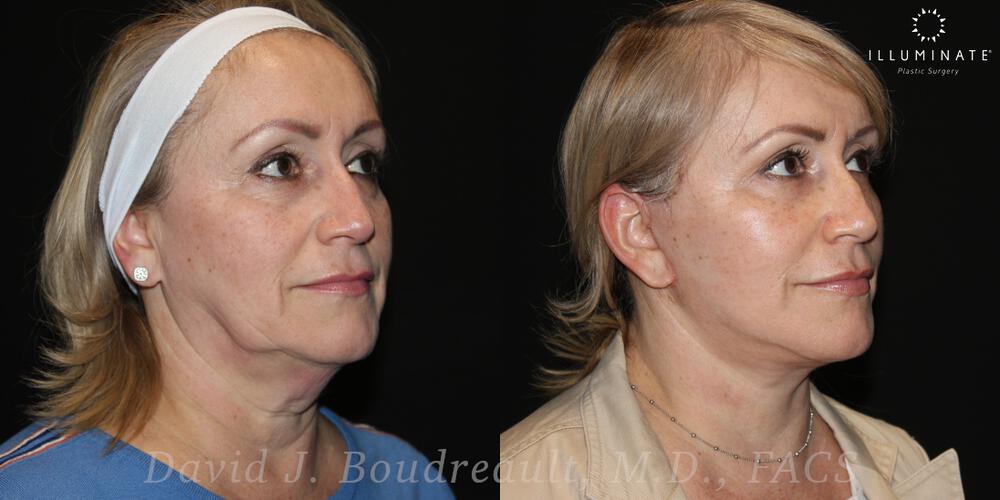 Face & Neck Lift Before & After Image