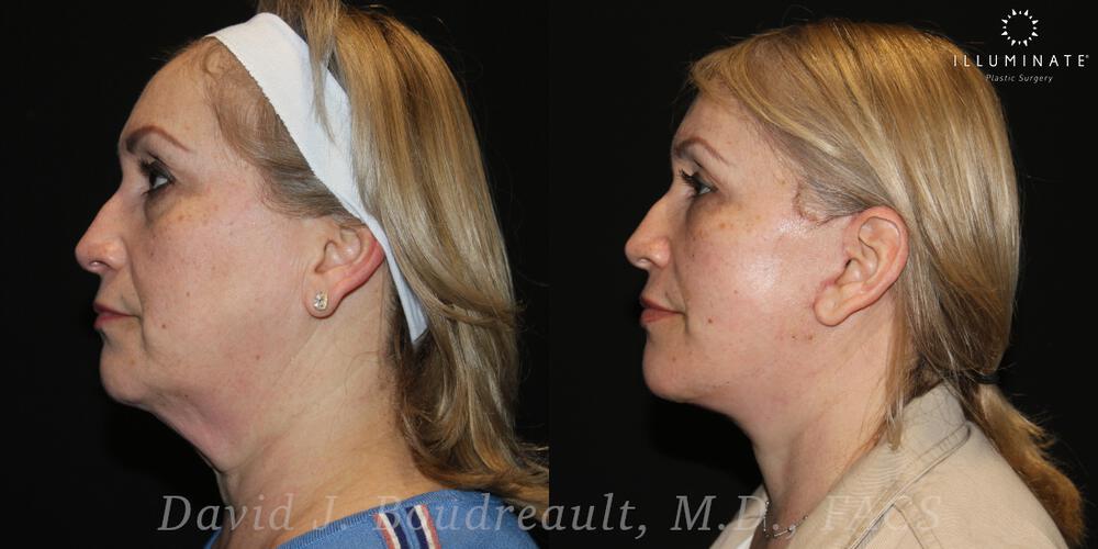 Face & Neck Lift Before & After Image