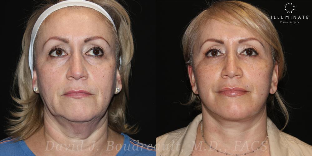 Face & Neck Lift Before & After Image