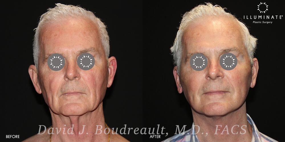 Face & Neck Lift Before & After Image