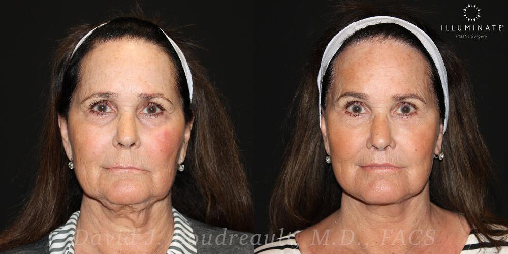 Face & Neck Lift Before & After Image