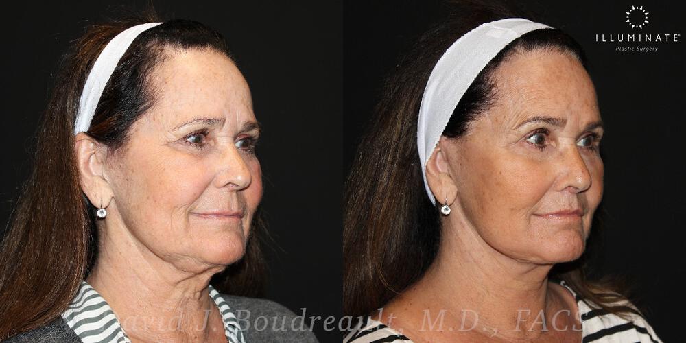 Face & Neck Lift Before & After Image