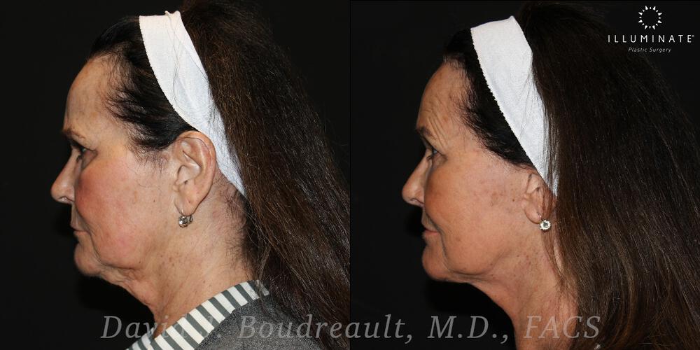 Face & Neck Lift Before & After Image