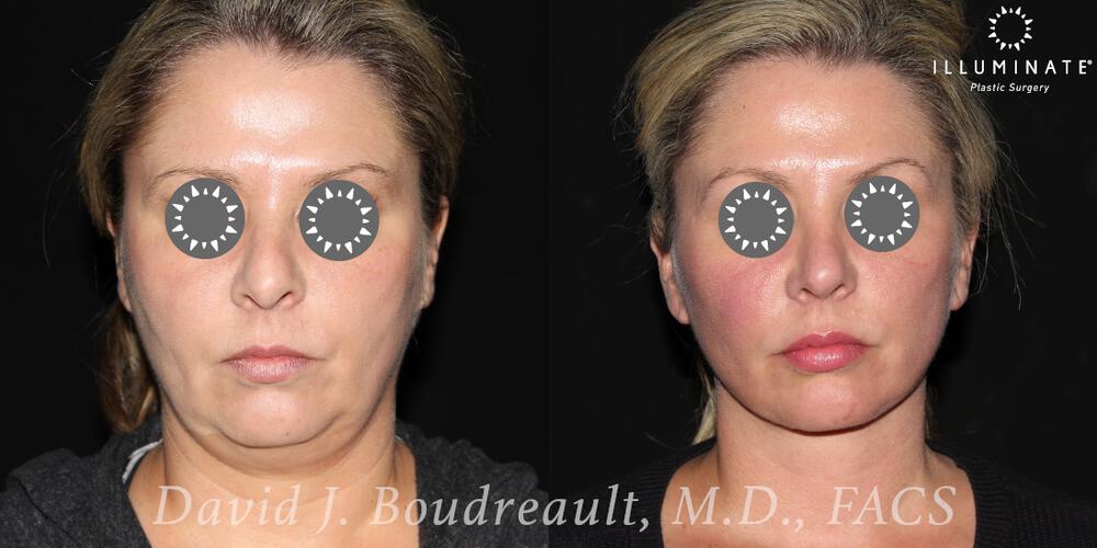 Face & Neck Lift Before & After Image