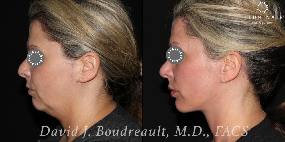 Face & Neck Lift Before & After Image