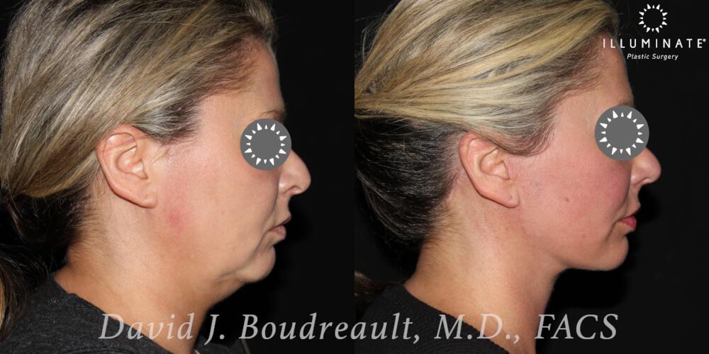 Face & Neck Lift Before & After Image