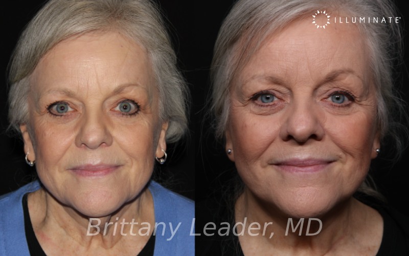 Face & Neck Lift Before & After Image