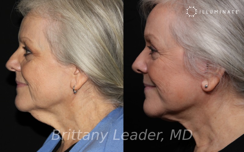 Face & Neck Lift Before & After Image