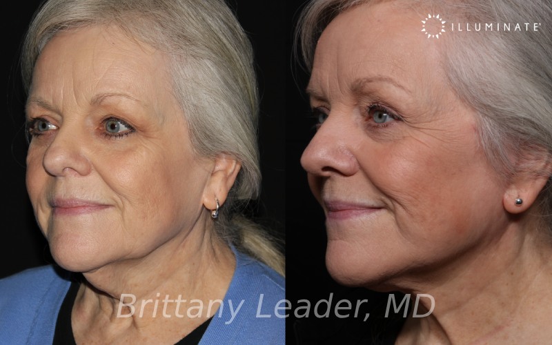 Face & Neck Lift Before & After Image