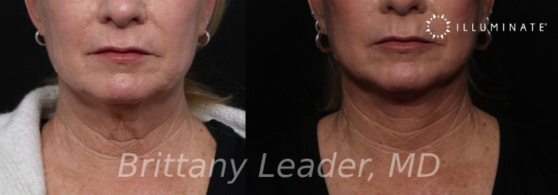 Face & Neck Lift Before & After Image