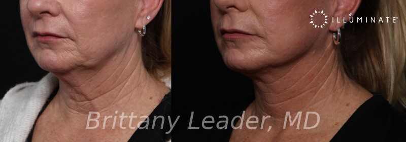 Face & Neck Lift Before & After Image