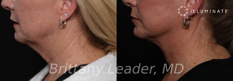 Face & Neck Lift Before & After Image